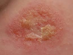 Image result for yellow scabs on the face in children