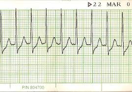 Psvt is rapid and regular. Supraventricular Tachycardia