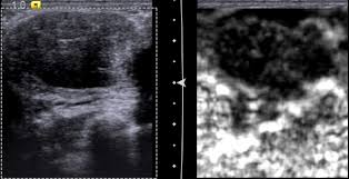 During a ct scan, you will be exposed to a small amount of radiation. Controversies And Practices In Breast Cancer Screening Healthcare In Europe Com