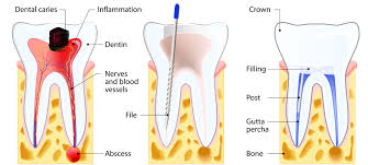 Check spelling or type a new query. Root Canal Treatment Ego Dental Clinic Westminster London