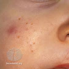More images for how to help baby acne on face » Your Baby S Skin Plunket