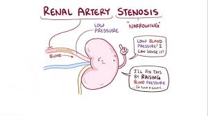 Each renal artery gives off small branches in its proximal course, prior to dividing into dorsal and ventral rami. Renal Artery Stenosis Osmosis