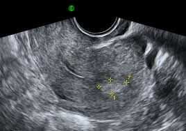 A systematic review of 17 observational studies including over 10. Chapter 6 Endometrial Polyps Melaka Fertility