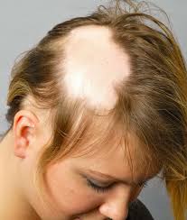 Your child's doctor will prescribe a medicine to treat ringworm of the scalp. What Is Hairloss Sainiherb