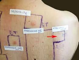 Image result for Patch Testing