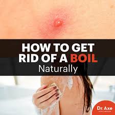 I have no other symptoms. Hot To Get Rid Of A Boil How To Prevent Boils Dr Axe