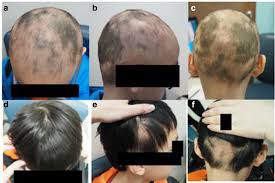 Image result for Anthralin