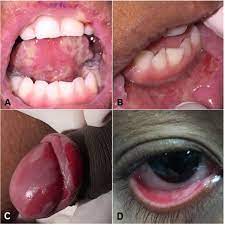 SciELO - Brasil - Childhood pemphigus vulgaris is a challenging diagnosis  Childhood pemphigus vulgaris is a challenging diagnosis