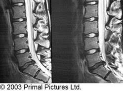 Whilst no pressure is applied to the doughnut Herniated Prolapsed Slipped Disc Bodymotion Spine Sports Injuries Clinic
