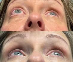 Image result for Proptosis