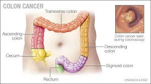 Image result for Colon Cancer Screening with Colonoscopy
