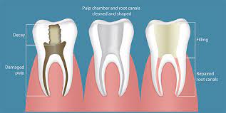 Maybe you would like to learn more about one of these? Sore Discolored Tooth You Might Need Root Canal Therapy