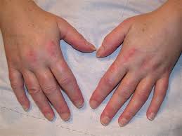 Image result for Polymyositis