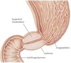 Noen ganger oppleves de første symptomene på magesår bare som mildt ubehag. Pylorusstenose Store Medisinske Leksikon