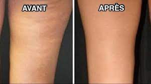 L'utilisation du marc de café pour éliminer la cellulite est une astuce beauté maison qui est adoptée par beaucoup d'utilisatrices. 16 Remedes Magiques Pour Se Debarrasser De La Cellulite