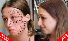 Tattoos that have not been effectively removed by other treatments or through home remedies may respond well to laser therapy providing the prior treatments did not result in excessive scarring. Tattoo Removal Face Tattoo Design