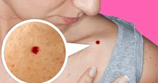 Leucemia puntos rojos en la piel. Causas De Los Puntos Rojos En La Piel Consejos De Salud