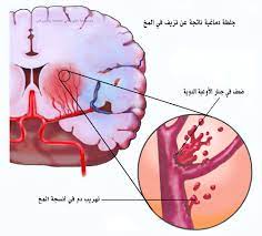 علاج توقف التنفس اثناء النوم يقلل من الجلطات الدماغية
