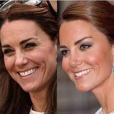 Turn Back The Hands Of Time Thanks To Botox Which Yields Natural And Soft Results That Will Leave You Looking Refr Botox Forehead Botox Fillers Botox Brow Lift