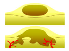 Physical characteristics of the lesion 3. Benign Tumor Wikipedia