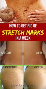 Lumpunderskinonarm In 2020 Stretch Mark Remedies Stretch Marks Stretch Marks Cure