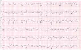 Clinicians who suspect myocarditis or pericarditis should consider consulting with a pediatric cardiologist, infectious disease specialist and/or rheumatologist. Autoimmune Myocarditis With Av Block Too Much Of A Good Thing American College Of Cardiology