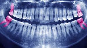 What are the symptoms of wisdom teeth coming in? Impacted Wisdom Tooth Treatment Recovery And More