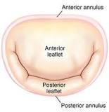 Image result for icd 10 code for mild mitral annular calcification