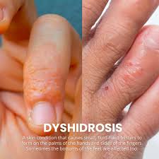 Image result for dyshidrosis