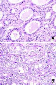 Omental mesothelioma is extremely rare, but it is possible and is probably associated with asbestos exposure. Immunohistochemical Analysis Of Hepatocellular And Adenocarcinoma In The Liver Moc31 Compares Favorably With Other Putative Markers Modern Pathology