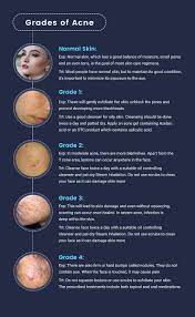 Grades Of Acne Skin Care Hair Care Acne Skin Care