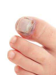 Seek immediate medical care for injured toes that are tingling, numb, cold, bluish, have bleeding open wound, or experience worsening pain that doesn't respond to pain medication. Does My Child Have A Broken Toe