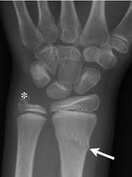 Paired cranial bones of the skull by dr khaled shoghy. Frontal Radiograph Of The Left Wrist In A 10 Year Old Boy Shows A Download Scientific Diagram