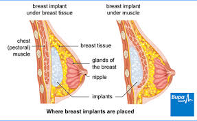 Maybe you would like to learn more about one of these? Breast Enlargement Health Information Bupa Uk