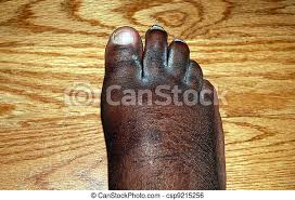 The foot ft to centimeter cm conversion table and conversion steps are also listed. Swollen Foot African American Man With A Swollen Foot Canstock