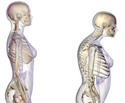 Decoctum ex turionĭbus pini ad bronchitĭdes chronĭcas parātur. Osteoporoza De La Dezinteres La Exagerare Cum Se Pune Corect Diagnosticul De Osteoporoza Si Care Sunt Recomandarile Pentru Testul De Osteodensitometrie Medlife