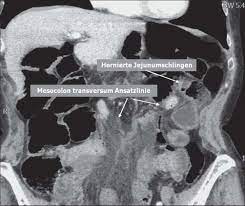 Als innere hernien gelten solche, die von außen und ohne hilfsmittel nicht zu erkennen sind, da sie sich innerhalb des rumpfes. Https Www Thieme Connect De Products Ejournals Pdf 10 1055 S 0032 1330740 Pdf