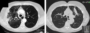 Bleeding from the back passage (rectum) or blood in your poo a change in your normal bowel habit, such as looser poo, pooing more often or constipation a lump that your doctor can feel in your back passage or tummy (abdomen), more commonly on the right side Stereotactic Body Radiation Therapy Of Colorectal Cancer Metastases An Overview Onkonytt