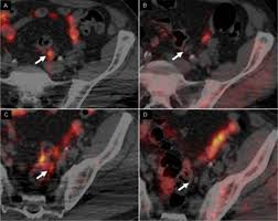 Symptoms of advanced prostate cancer. Novel Pet Imaging Agent Targets Copper In Tumors Detects Prostate Cancer Recurrence Early Imaging Technology News