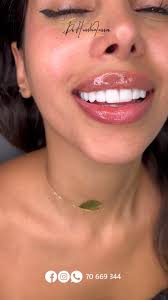 Emax veneers, #drhusseinalinasser, 📞 70669344, 📍Airport street