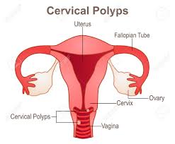 The cervix looks a little bit like a donut. A Cervical Polyp Is A Common Benign Polyp Or Tumour On The Surface Of The Cervical Canal Royalty Free Cliparts Vectors And Stock Illustration Image 142893505