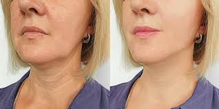 Check spelling or type a new query. Thread Lift Non Surgical Face Lift In Altrincham Cheshire Revolution Aesthetics