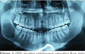 This study records the clinicopathological features of jaw osteosarcomas diagnosed histologically in the. Pdf Osteosarcoma Of The Mandible A Case Report Of A Rare Variant Semantic Scholar