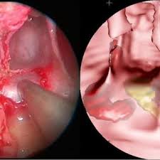 Maybe you would like to learn more about one of these? Left Real Endoscopic View On The Sellar Floor The Suction Tool Download Scientific Diagram
