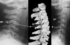 Thoracic transverse process fractures (ttpfs) are injuries that go unnoticed during traditional autopsies, as demonstrated by a lack of medicolegal publications regarding ttpfs. Radiology In Ped Emerg Med Vol 5 Case 2