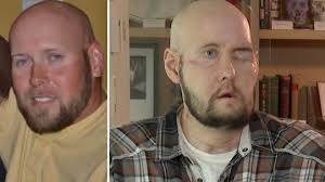 Förlorade halva ansiktet