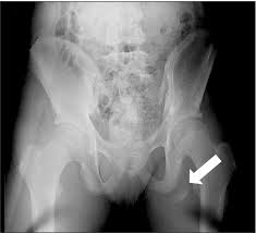 When to seek medical help. Pelvis Outlet Radiograph Showing Avulsion Fracture Of Ischial Download Scientific Diagram