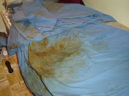 Image result for Fecal Incontinence