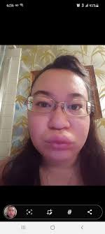 What is allergy swelling?