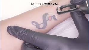 Tattoo removal is a procedure whereby an indelible tattoo design is removed from the face or body of the patient. Philaser Phiacademy